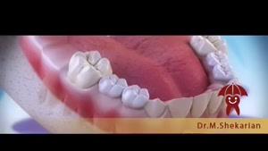 از دست رفتن زودتر از موعد دندان های شیری چه عوارضی دارد؟