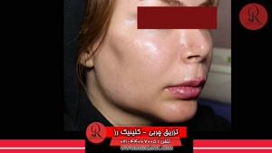 تزریق چربی | فیلم تزریق چربی | کلینیک پوست و مو رز | شماره38