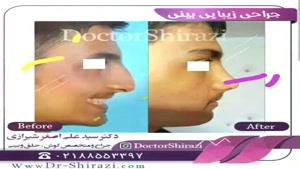 جراحجی بینی دکتر شیرازی
