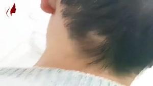 درمان ریزش مو منطقه ای | دکتر صفیه چعباوی زاده متخصص پوست، مو و زیبایی