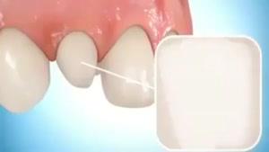 کامپوزیت دندان ها