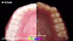 قبل و بعد از درمان ارتودنسی دندان