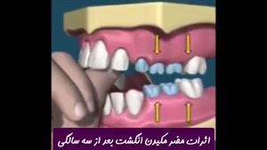 مضرات مکیدن انگشت بعد از سه سالگی | دکتر ندا هادی جراح و دندانپزشک زیب