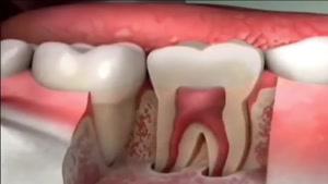 ترک دندان چه علائمی دارد