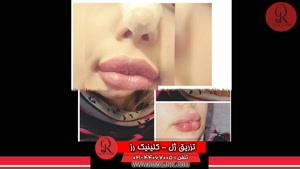 تزریق ژل | فیلم تزریق ژل | کلینیک پوست و مو رز | شماره 37