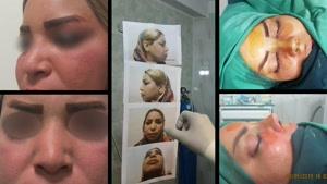 نمونه جراحی زیباییی بینی با کمک غضروف دنده