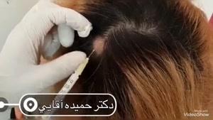 درمان ریزش موی سکه ای با مزوتراپی