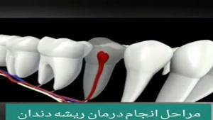فیلم مراحل انجام درمان ریشه دندان