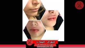 تزریق ژل | فیلم تزریق ژل | کلینیک پوست و مو رز | شماره 42