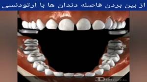 فیلم ازبین بردن فاصله دندان ها با ارتودنسی