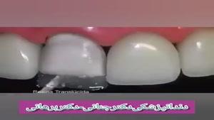 ترمیم و بازسازی واصلاح بد رنگی دندان سانترال