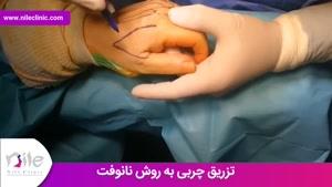 تزریق چربی | فیلم تزریق چربی | کلینیک پوست و مو نیل | شماره 8