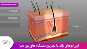 لیزر موهای زائد | کلینیک پوست و مو نیل | شماره 3