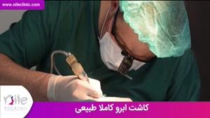 کاشت ابرو | فیلم کاشت ابرو | کلینیک پوست و مو نیل | شماره 8