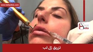 تزریق ژل | فیلم تزریق ژل | کلینیک پوست و مو هلیا | شماره 7