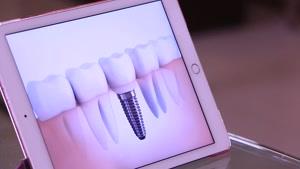 نکات تکمیلی پوسیدگی دندان|کلینیک دندانپزشکی مدرن