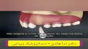 درمان و ترمیم شکستگی دندان