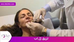 تزریق ژل | فیلم تزریق ژل | کلینیک پوست و مو نیل | شماره 13