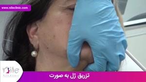 تزریق ژل | فیلم تزریق ژل | کلینیک پوست و مو نیل | شماره 19