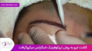کاشت ابرو | فیلم کاشت ابرو | کلینیک پوست و مو نیل | شماره 17