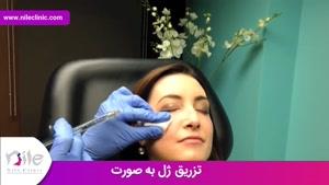 تزریق ژل | فیلم تزریق ژل | کلینیک پوست و مو نیل | شماره 21