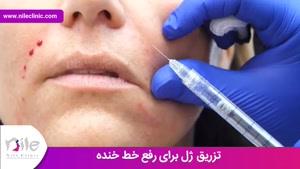 تزریق ژل | فیلم تزریق ژل | کلینیک پوست و مو نیل | شماره 15