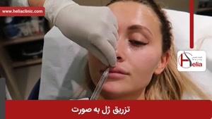 تزریق ژل | فیلم تزریق ژل | کلینیک پوست و مو هلیا | شماره 22