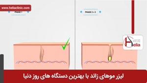 لیزر موهای زائد | فیلم لیزر موهای زائد |کلینیک پوست و مو هلیا |شماره11