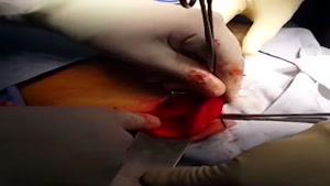 فیلم عمل جراحی فتق توسط دکتر محمد رنجبری