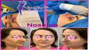 فیلم جراحی بینی توسط دکتر رفیع پرنیا
