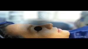 فیلم عمل زیبایی بینی استخوانی زنانه