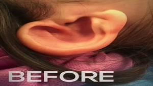فیلم جراحی زیبایی گوش های برجسته