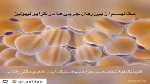لاغری با لیزر کرایولیپولیز توسط دکتر همایون زهتاب در اهواز 