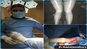 عمل جراحی اصلاح پای پرانتزی توسط فوق تخصص زانو در تهران