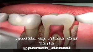 علائم ترک دندان
