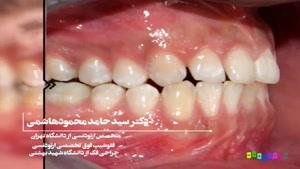 درمان بی نظمی دندان
