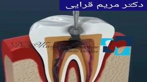 عصب کشی دندان چقدر طول می کشد؟