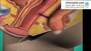 درمان فیستول مقعدی با لیزر بدون بازگشت در کلینیک زارعی