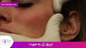 تزریق ژل | فیلم تزریق ژل | کلینیک پوست و مو نیل | شماره 27