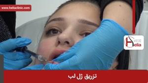 تزریق ژل | فیلم تزریق ژل | کلینیک پوست و مو هلیا | شماره 27