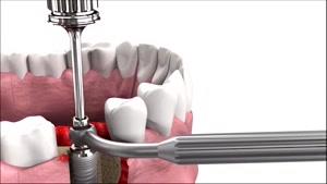 ایمپلنت یک روزه|کلینیک دندانپزشکی مدرن