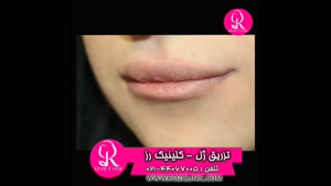 فیلم تزریق ژل | کلینیک رز | 02144067005 | شماره 107