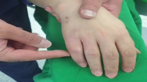 نتیجه عمل اصلاح کج جوش خوردن انگشت دست