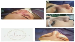 جراحی بینی 