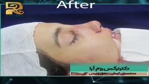 نمونه جراحی بینی بعد از عمل