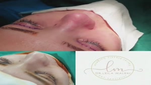 جراحی همزمان زیبایی پلک بالا و جراحی بینی
