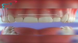 چگونه طول تاج دندان را افزایش میدهیم