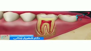 عوارض پوسیدگی دندان