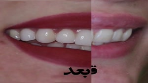 ونیر کامپوزیت دندان