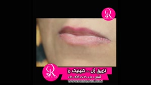 فیلم تزریق ژل | کلینیک رز | 02144067005 | شماره 112